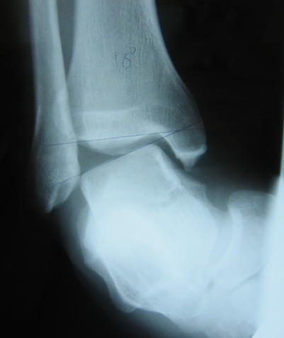 Figura 1: Teste do Tilt Talar positivo em imagem radiográfica demonstrando a ICT Fonte: Foot Ankle Orthop. 2019 Apr; 4(2): 2473011419846938.