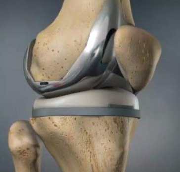 Ilustração da prótese de joelho