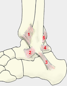 Figura 3: Ligamentos do complexo lateral do tornozelo. Ligamento tibiofibular anterior, (2) Ligamento talofibular anterior, (3) Ligamento calcaneofibular, (4) Ligamento talofibular posterior, (5) Ligamento tibiofibular posterior. Fonte: Halabchi F, Hassabi M. Acute ankle sprain in athletes: Clinical aspects and algorithmic approach. World J Orthop 2020; 11(12): 534-558.