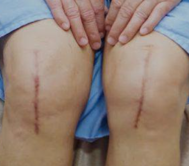 Figura 5: aspecto cicatricial pós cirurgia (fonte: google)
