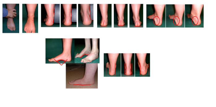 Figura 6: Os 6 itens que compõem o FPI-6. Fonte: Martinez BR, De Oliveira JC, Vieira KVSG & Yi LC (2019): Translation, Cross-cultural Adaptation and Reliability of The Foot Posture Index (FPI-6) - Brazilian Version, Physiotherapy Theory and Practice.