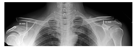 Figura 3. Exemplo de imagem radiográfica apresentando luxação acromioclavicular no ombro direito. Fonte: https://ortopediaeombro.com.br/luxacao-acromioclavicular/