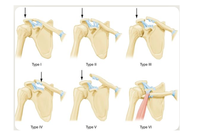 Figura 4. Tipos de luxação acromioclavicular. Fonte: https://shoulderinstitute.co.za/acromioclavicular-joint-dislocation/