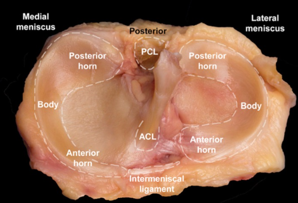 Figura 1. Meniscos e estruturas associadas. Posterior horn - Corno posterior; Body - corpo do menisco; Anterior horn - Corno anterior; ACL - Ligamento Cruzado Anterior (LCA); PCL - Ligamento Cruzado Posterior (LCP); Intermeniscal ligament - Ligamento intermeniscal. Fonte: Atlas de anatomia Humana, Netter.