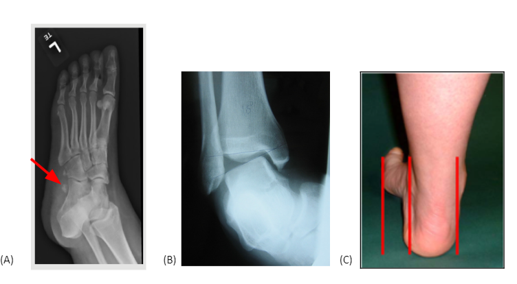 Figura 4: Fatores de risco para tendinopatia de fibulares. (A) Os peroneum; (B) Instabilidade Crônica de Tornozelo; (C) Pé cavo varo. Fonte: Sharma, A., & Parekh, S. G. (2020). Pathologies of the Peroneals: A Review. Foot & Ankle Specialist, 193864002091627.