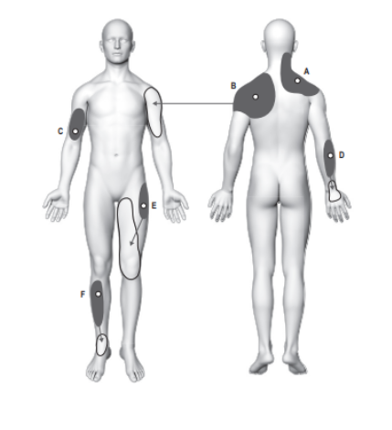 Figura 3. Áreas típicas de dor local aumentada (mostradas em cinza escuro) e áreas distintas de dor referida (mostradas em branco) experimentadas após injeção intramuscular de solução salina hipertônica (local indicado por ponto branco) no trapézio (A), infraespinhal (B), bíceps braquial (C), músculos braquiorradial (D), vasto lateral (E) e tibial anterior (F). Fonte: Cesar Fernández-de-las-Peñas, Juan Mesa-Jiménez Madrid, Spain January 2018.
