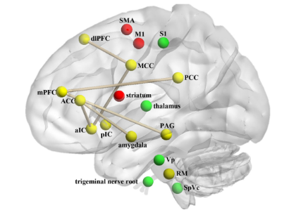 Figura 4. Representação esquemática das principais regiões cerebrais com estrutura e função alteradas envolvidas na dor relacionada à DTM (disfunção temporomandibular). Bolas verdes representam as áreas no sistema trigemino-talamo-cortical clássico. Bolas vermelhas estão no sistema motor. Bolas amarelas são as regiões corticais cerebrais implicadas na percepção e modulação da dor. As regiões cerebrais com conectividade funcional alterada na DTM estão conectadas por linhas em cáqui. Abreviações: SMA, áreas motoras suplementares; dlPFC, córtex pré-frontal dorsolateral; M1, córtex motor primário; S1, córtex somatossensorial primário; MCC, córtex cingulado médio; mPFC, córtex pré-frontal medial; ACC, córtex cingulado anterior; PCC, córtex cingulado posterior; aIC, córtex insular anterior; pIC, córtex insular posterior; PAG, periaqueduto cinzento; Vp, núcleo sensitivo principal do trigêmeo; RM, raphe magnus; SpVc, subnúcleo caudal do trato espinhal. Fonte: Yin et al. The Journal of Headache and Pain (2020) 21:78.