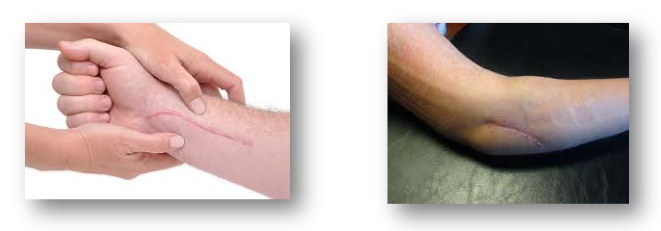 Figura 25. Cuidados com a cicatriz, mobilização de cicatriz para evitar aderências cicatriciais. Fonte: Imagens retiradas da internet.