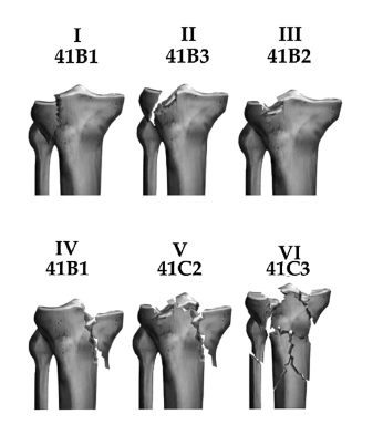 Figura 2. Tipos de I a VI da classificação de Schatzker; 41B1 a 41C3, classificação da AO pra FPT. Fonte: kfuri Junior, 2009.