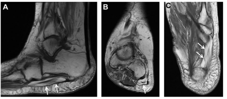 Figura 13: (A) Sagital, (B) coronal e (C) axial em T1 mostrando a atrofia do músculo abdutor do dedo mínimo, compatível com a síndrome de Baxter (encarceramento do nervo calcâneo inferior). Fonte: Latt LD. et al., 2020.