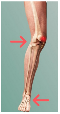 Figura 2. Representação de uma força lateral aplicada ao joelho, causando estresse em valgo. Fonte: Imagem retirada da internet.