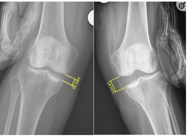 Figura 4. Radiografia com joelho na posição de estresse em valgo, neste caso mostrando abertura no compartimento medial maior que 8 mm. Fonte: https://doi.org/10.22038%2Fabjs.2021.48458.2401.