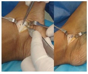 Figura 26: Cirurgia minimamente invasiva do tendão tibial posterior: sinovectomia endoscópica. Fonte: https://www.svcot.org/ediciones/2021/1/art-4/