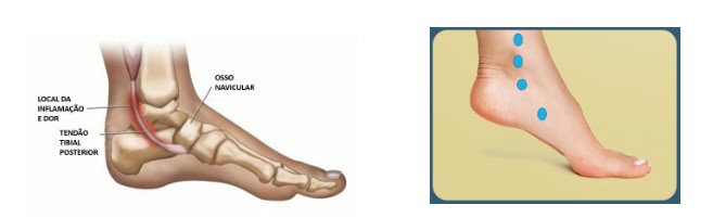 Figura 9: Pontos de palpação em pacientes com TTP. Fonte: https://me.med.br/tendinopatia-do-tibial-posterior/